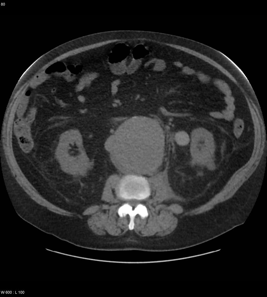 Abdominal aortic aneurysm with intramural hematoma then rupture (Radiopaedia 50278-55631 Axial non-contrast 76).jpg