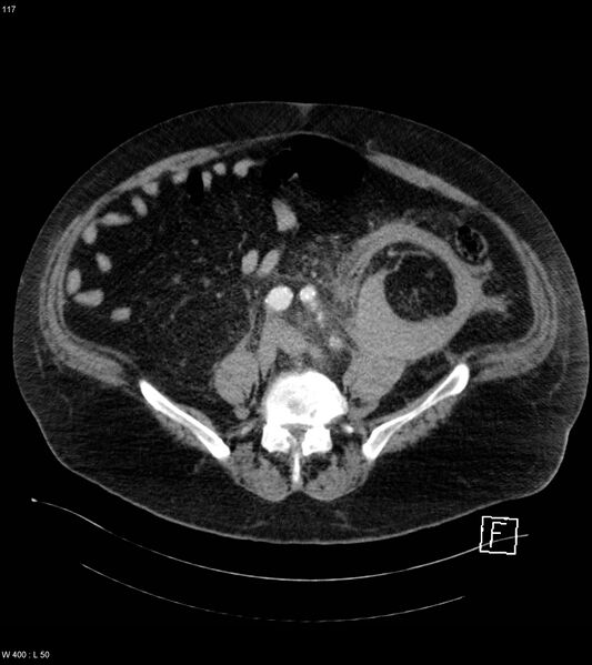 File:Abdominal aortic aneurysm with intramural hematoma then rupture (Radiopaedia 50278-55632 Axial C+ arterial phase 116).jpg