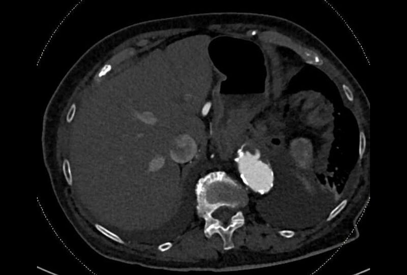 File:Abdominal aortic aneurysm with thrombus fissuration (Radiopaedia 73192-83919 Axial C+ arterial phase 13).jpg