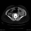 Abdominal wall endometriosis (Radiopaedia 25723-25885 Axial C+ portal venous phase 21).jpg