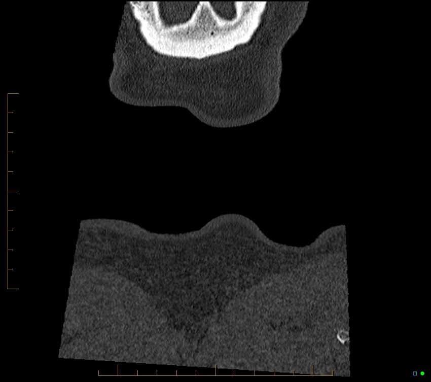 Accessory articulation of cervical transverse processes (Radiopaedia 82715-96933 Coronal non-contrast 140).jpg