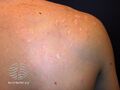 Acne affecting the back images (DermNet NZ acne-acne-back-149).jpg