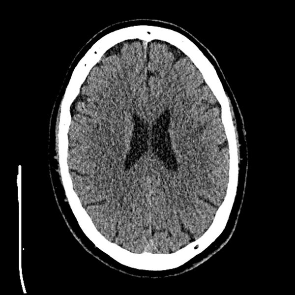 File:Acute A3 occlusion with ACA ischemic penumbra (CT perfusion) (Radiopaedia 72036-82525 Axial non-contrast thins 63).jpg