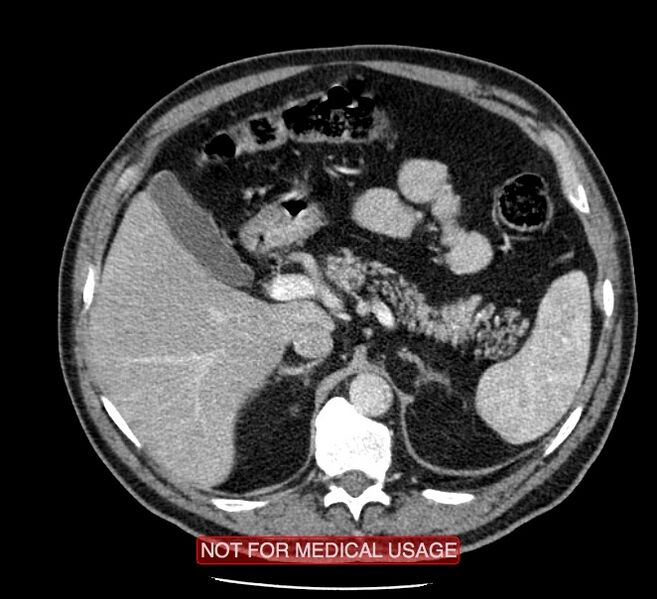 File:Acute aortic dissection - Stanford type A (Radiopaedia 40661-43285 Axial C+ portal venous phase 78).jpg
