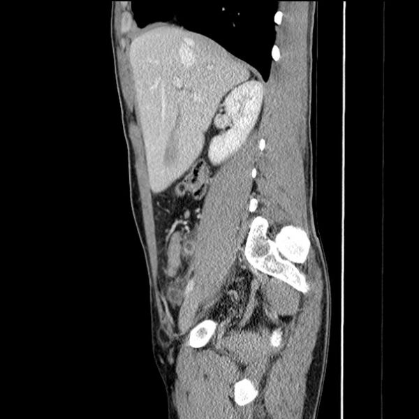File:Acute appendicitis (Radiopaedia 27049-27227 Sagittal C+ portal venous phase 27).jpg