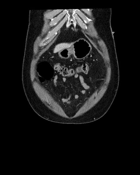 File:Acute appendicitis - large appendicoliths (Radiopaedia 61805-69820 Coronal C+ portal venous phase 23).jpg
