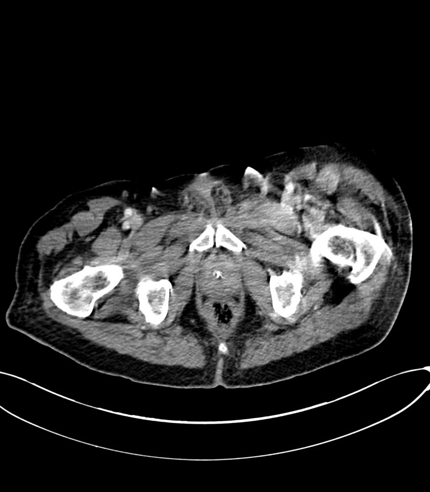 Acute arterial mesenteric ischemia (Radiopaedia 78238-90828 Axial C+ portal venous phase 145).jpg