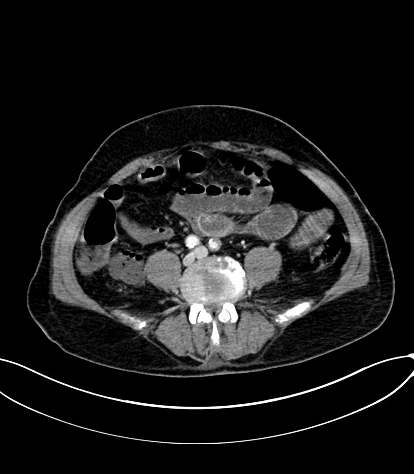 Acute arterial mesenteric ischemia (Radiopaedia 78238-90828 Axial C+ portal venous phase 90).jpg
