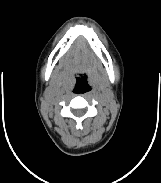 File:Acute bacterial tonsillitis (Radiopaedia 22882-22908 Axial non-contrast 25).png