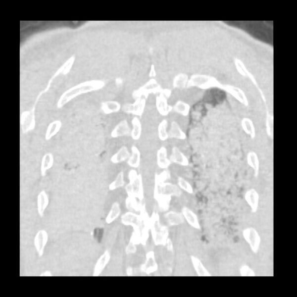 File:Acute diffuse alveolar hemorrhage (Radiopaedia 41323-44158 Coronal lung window 51).jpg