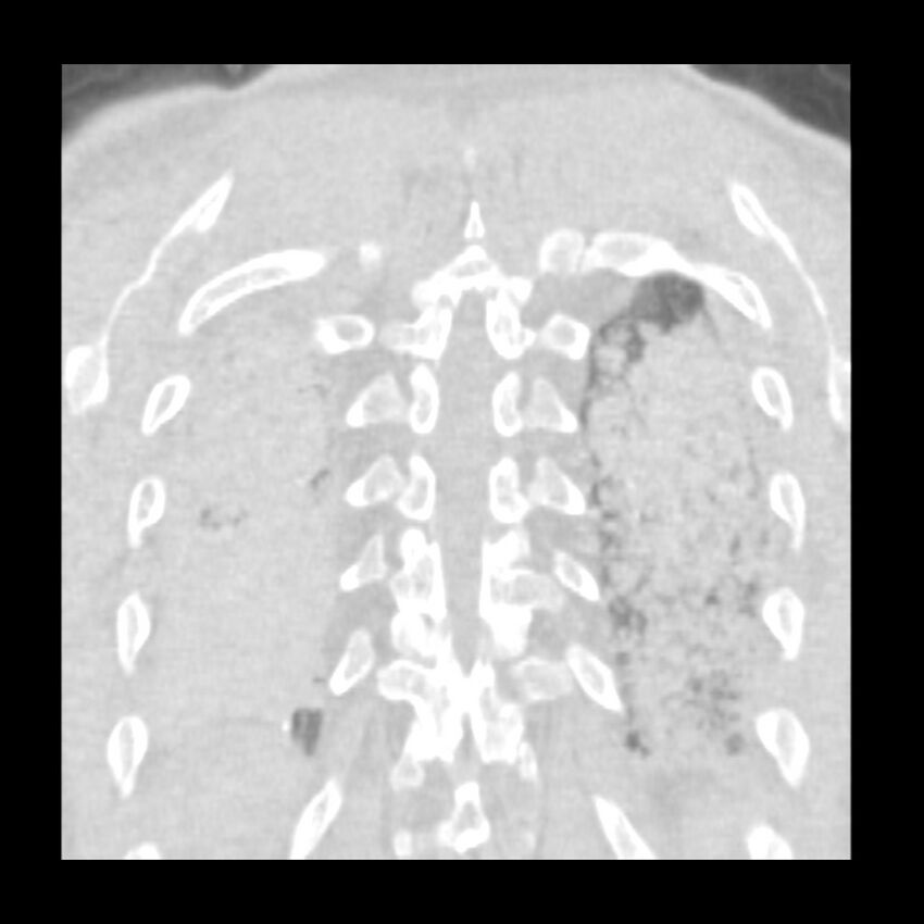 Acute diffuse alveolar hemorrhage (Radiopaedia 41323-44158 Coronal lung window 51).jpg