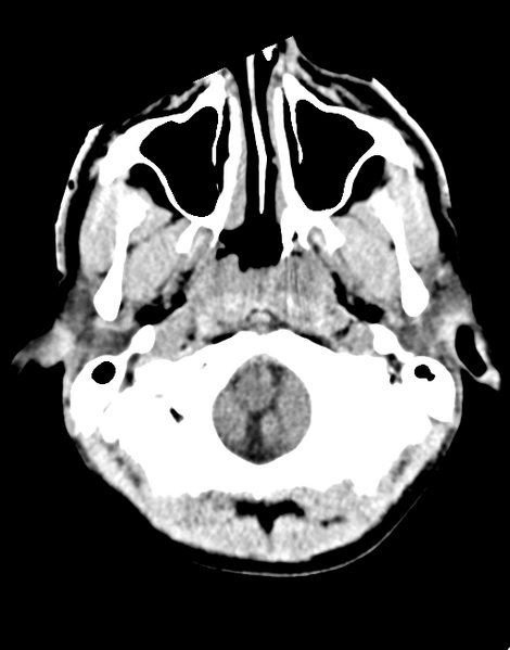 File:Acute disseminated encephalomyelitis (ADEM) (Radiopaedia 65319-74348 Axial non-contrast 4).png