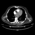 Acute heart failure (CT) (Radiopaedia 79835-93075 Axial C+ arterial phase 25).jpg