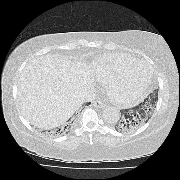 File:Acute interstitial pneumonitis (Radiopaedia 45404-49452 Axial lung window 71).jpg