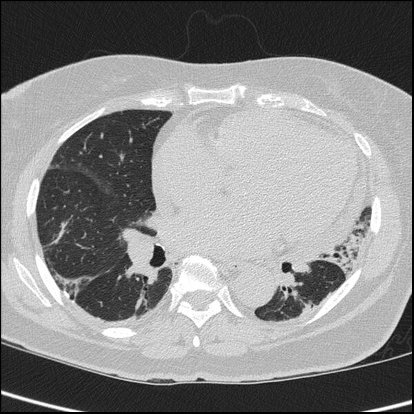 File:Acute interstitial pneumonitis (Radiopaedia 45404-49453 Axial lung window 50).jpg