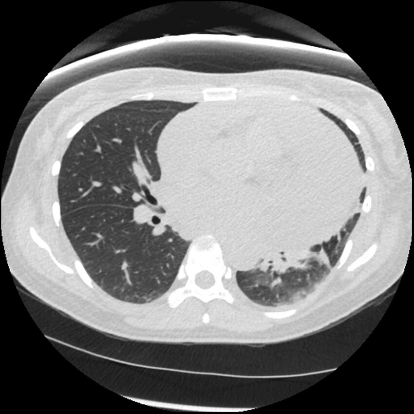 Acute lupus nephritis (Radiopaedia 45832-50107 Axial lung window 49).jpg