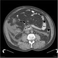 Acute pancreatitis (Radiopaedia 19135-19116 Axial non-contrast 30).jpg