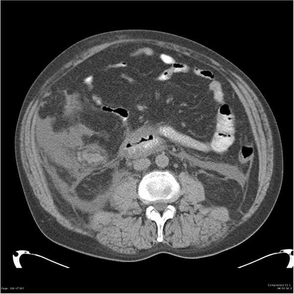 File:Acute pancreatitis (Radiopaedia 19135-19116 Axial non-contrast 30).jpg