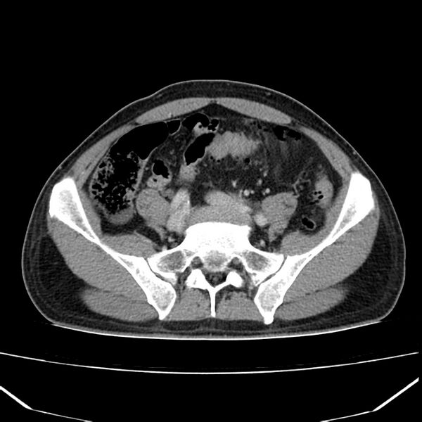 File:Acute pancreatitis (Radiopaedia 22572-22596 Axial C+ portal venous phase 53).jpg