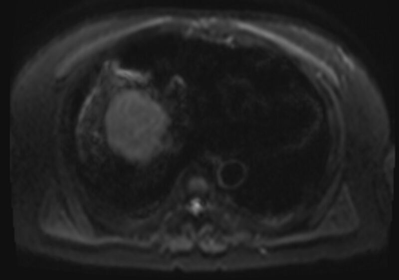 File:Acute portal vein thrombosis (Radiopaedia 73198-83925 Axial DWI 5).jpg