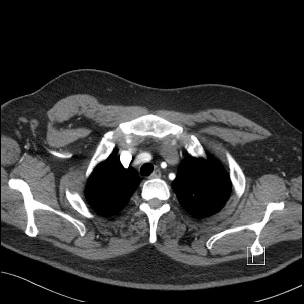 File:Acute pulmonary embolism with pulmonary infarct (Radiopaedia 73062-83768 Axial C+ CTPA 8).jpg