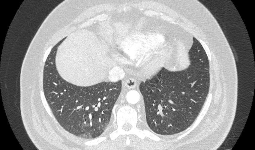 Acute pulmonary embolism with pulmonary infarcts (Radiopaedia 77688-89908 Axial lung window 98).jpg