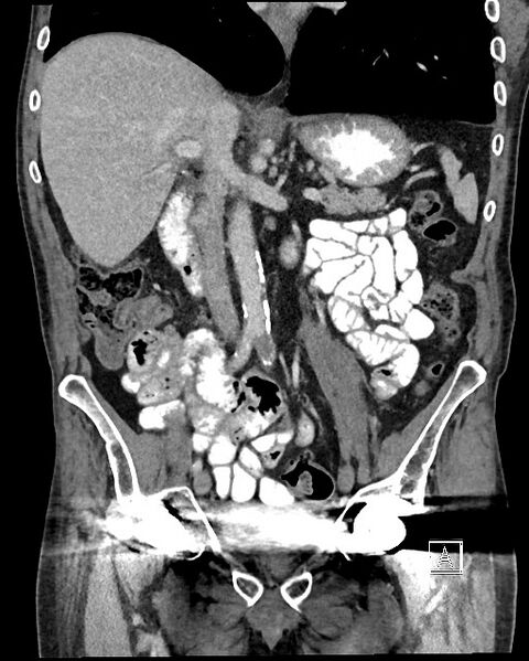 File:Acute renal infarction - rim capsular enhancement (Radiopaedia 59833-67270 Coronal C+ portal venous phase 25).jpg