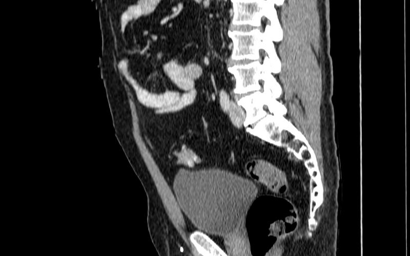 File:Acute sigmoid colon diverticulitis (Radiopaedia 55507-61976 Sagittal C+ portal venous phase 14).jpg