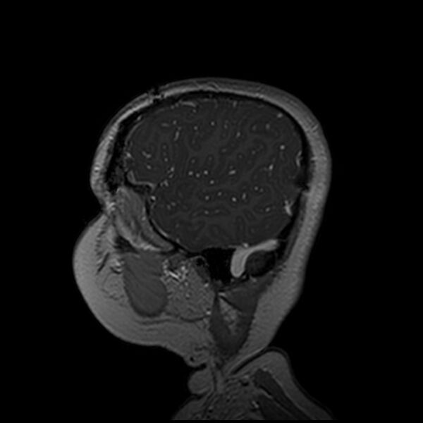 File:Adamantinomatous craniopharyngioma (Radiopaedia 77407-89529 H 103).jpg
