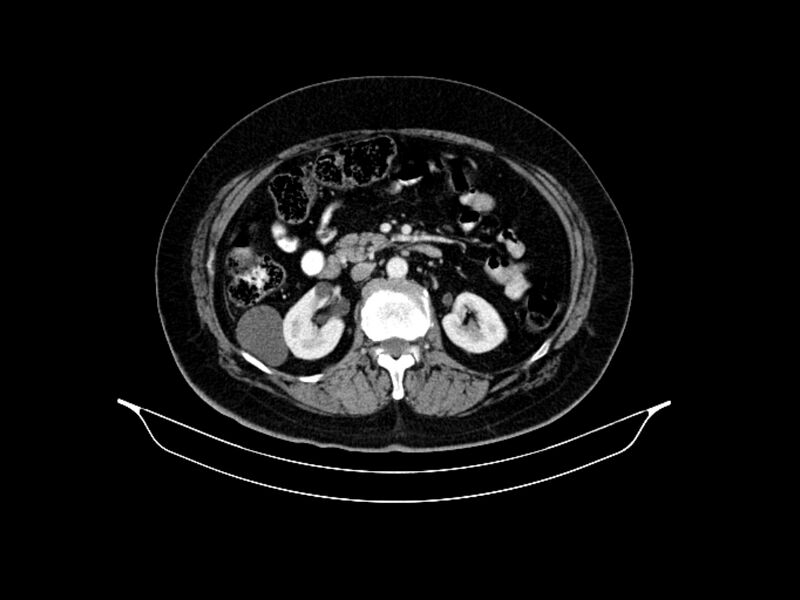 File:Adenocarcinoma of pancreas with hepatic metastasis (Radiopaedia 64332-73122 Axial C+ portal venous phase 45).jpg