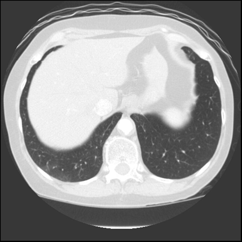 Adenocarcinoma of the lung (Radiopaedia 41015-43755 Axial lung window 107).jpg