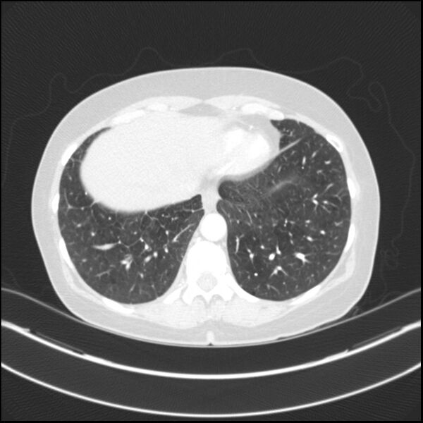 File:Adenocarcinoma of the lung (Radiopaedia 44205-47803 Axial lung window 72).jpg