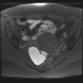 Adenomyosis and endometriotic cysts (Radiopaedia 82300-96367 Axial T1 fat sat 16).jpg