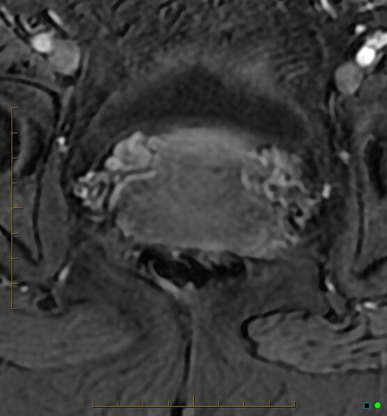 File:Adenomyosis uterus with hematometra (Radiopaedia 45779-50011 Axial T1 C+ fat sat 49).jpg