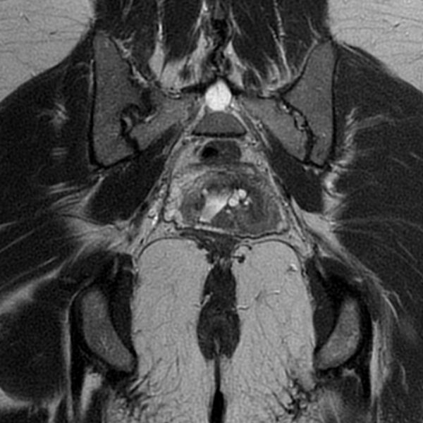 File:Adenomyosis within a septate uterus (Radiopaedia 69963-79981 Coronal T2 27).jpg