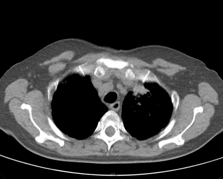 File:Adenosquamous lung carcinoma (Radiopaedia 22035-22030 non-contrast 18).jpg
