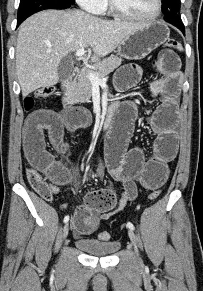 File:Adhesional small bowel obstruction (Radiopaedia 58900-66131 Coronal C+ portal venous phase 123).jpg