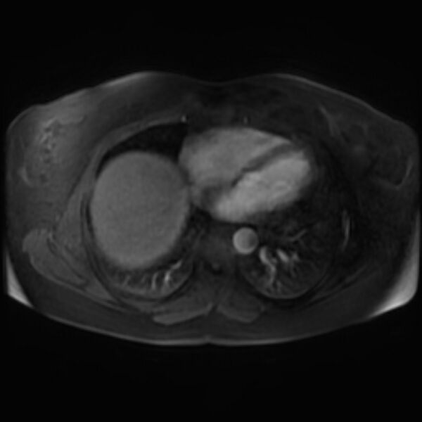File:Adrenal cortical carcinoma (Radiopaedia 70906-81116 Axial Postcontrast-Dyn T1 fat sat 1).jpg