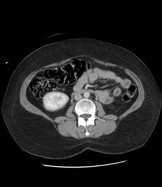 File:Adrenal cortical carcinoma with IVC invasion and thrombosis (Radiopaedia 34307-35597 Axial C+ portal venous phase 46).jpg