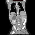 Adrenal hemorrhage (Radiopaedia 9390-10077 Coronal C+ portal venous phase 7).jpg