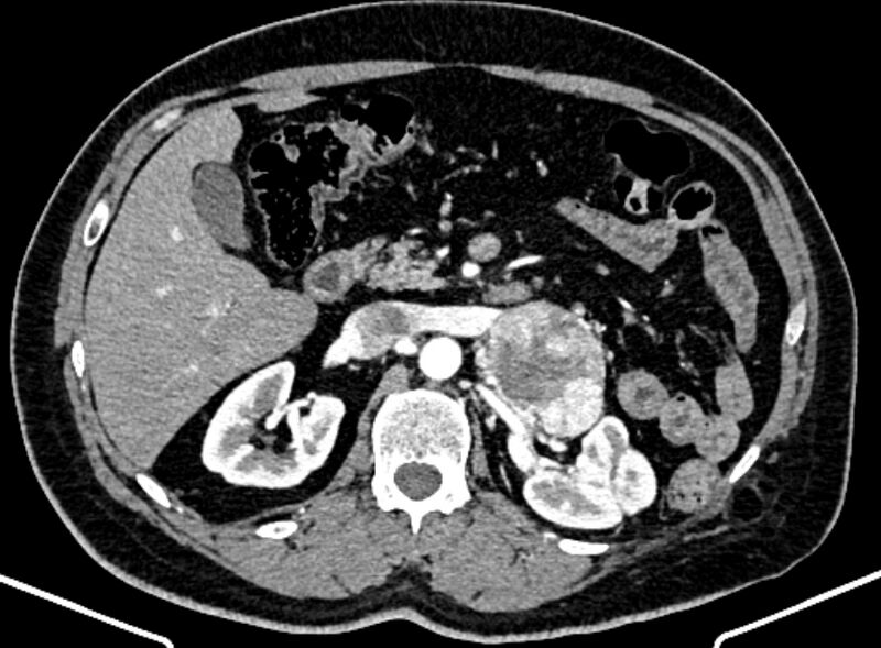 File:Adrenal metastases (Radiopaedia 73082-83791 Axial C+ arterial phase 65).jpg