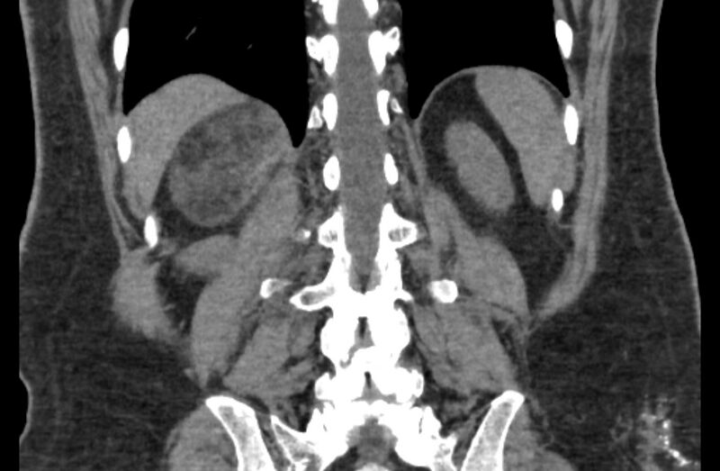 File:Adrenal myelolipoma (Radiopaedia 65240-74253 Coronal non-contrast 56).jpg