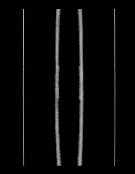 File:Adrenal myelolipoma - bilateral (Radiopaedia 74805-85810 Coronal C+ portal venous phase 6).jpg