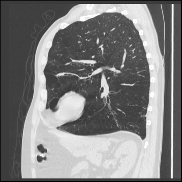 File:Alpha-1-antitrypsin deficiency (Radiopaedia 40993-43722 Sagittal lung window 88).jpg