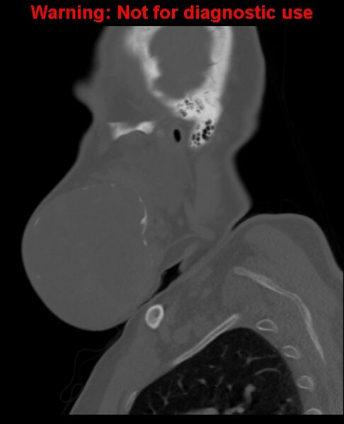 File:Ameloblastoma (Radiopaedia 33126-34164 Sagittal bone window 18).jpg