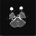 Amnestic syndrome secondary to hypoxic brain injury (Radiopaedia 24743-25004 ADC 9).jpg