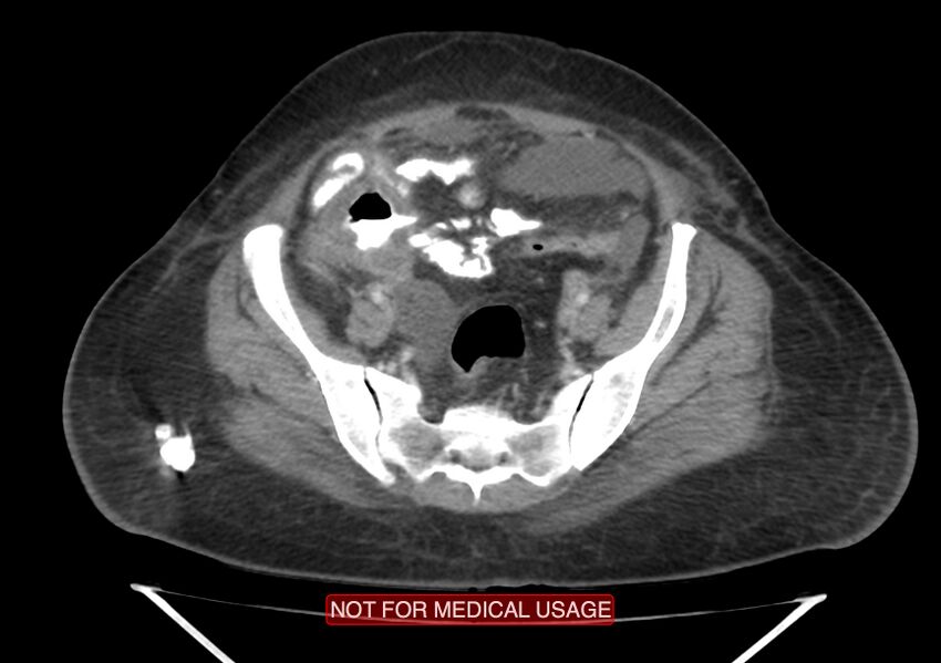 Amoebic enterocolitis with liver abscess (Radiopaedia 35100-36609 A 65).jpg