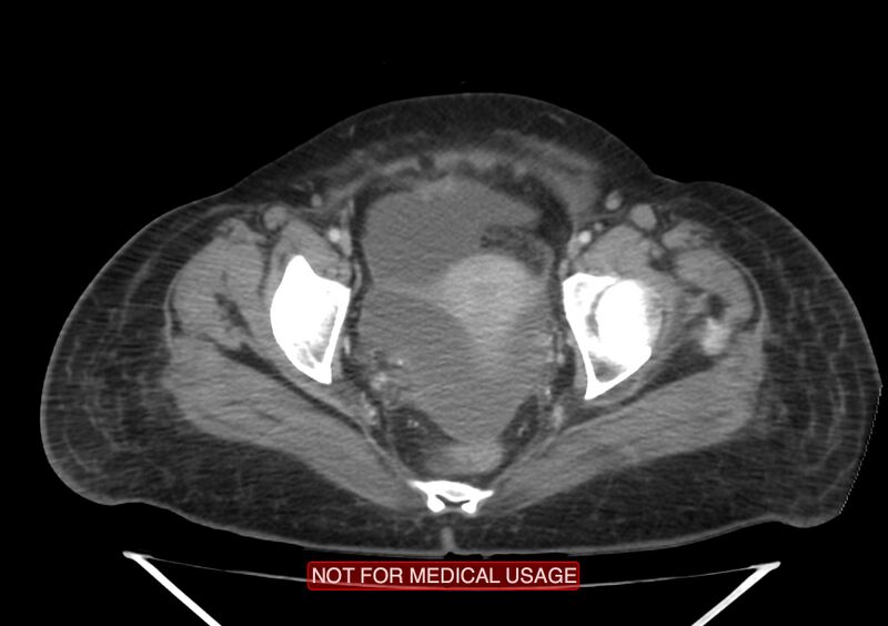 File:Amoebic enterocolitis with liver abscess (Radiopaedia 35100-36609 A 75).jpg