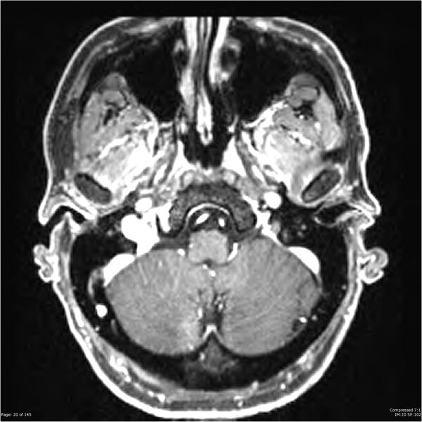 File:Anaplastic meningioma with recurrence (Radiopaedia 34452-35788 Axial T1 C+ 20).jpg