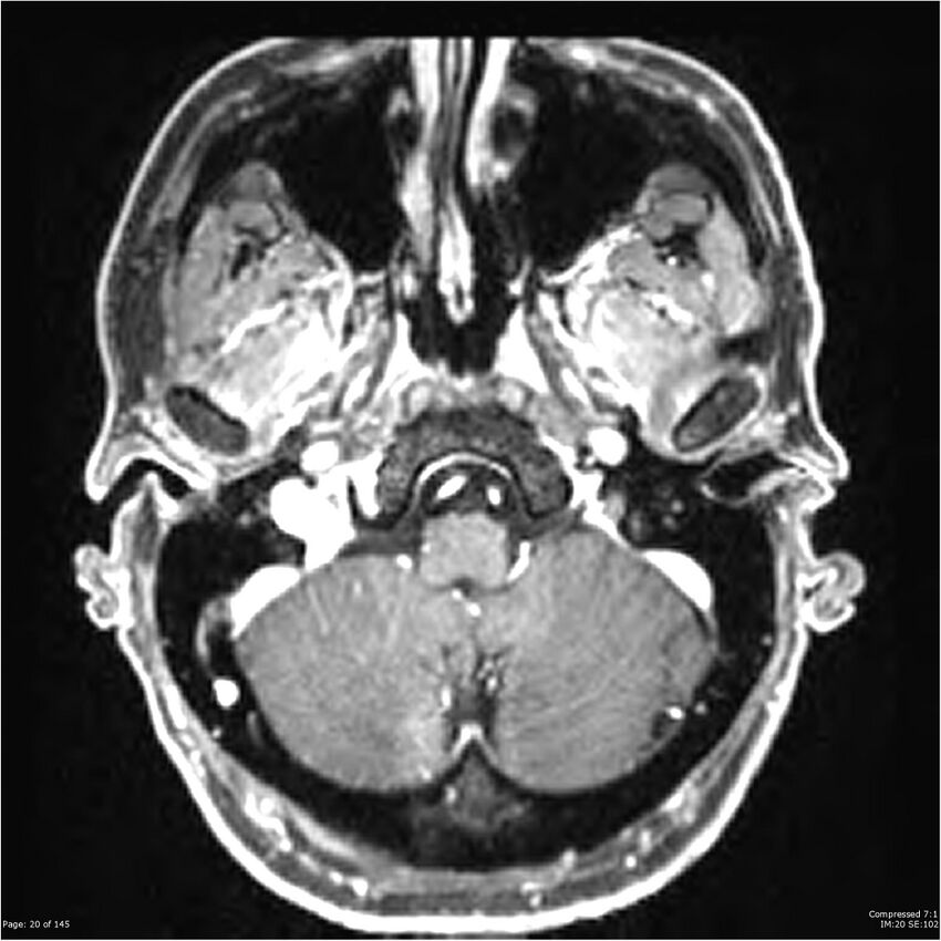 Anaplastic meningioma with recurrence (Radiopaedia 34452-35788 Axial T1 C+ 20).jpg